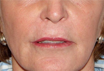 Juvederm for Lip Border and Lip Lines after 123684