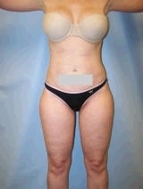 Liposuction Surgery after 139123