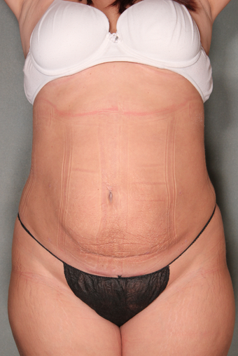 SmartLipo™ after 529476