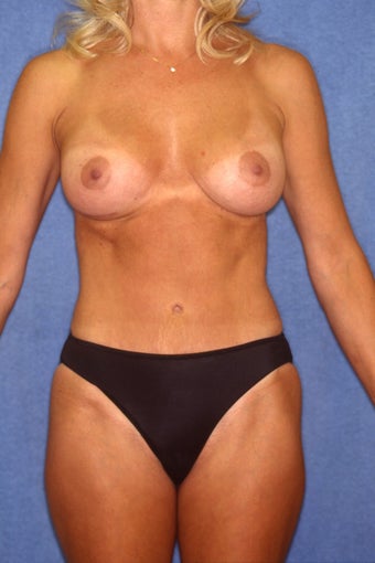 Tummy Tuck with Liposuction after 410395
