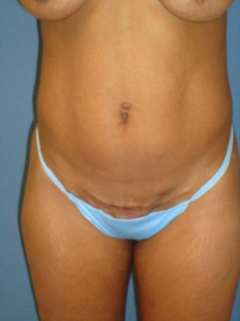 Mini Tummy Tuck 346173