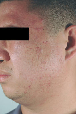 Laser Acne Scar Removal before 86374