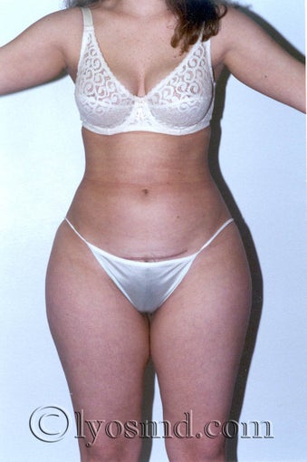 Liposuction before 225379
