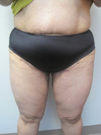 Inner Thigh Lift 328655