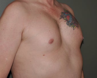 Pec Implants 521679