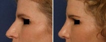 Rhinoplasty revision before 130782
