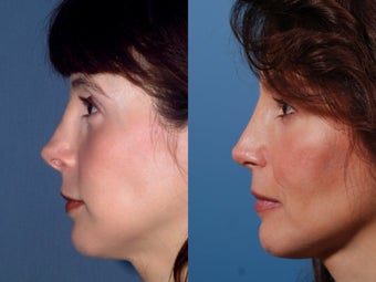 Revision rhinoplasty after 437931