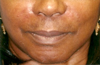 Restylane injection after 401308