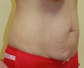 Abdominoplasty (Tummy Tuck) and Breast Augmentation before 216688