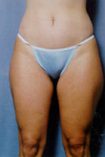 Suction Lipectormy of Inner and Outer thighs before 427988