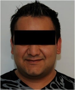 Smartlipo Neck before 123629
