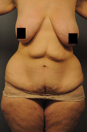 Abdominoplasty, abdominal and flank liposuction, beltlipectomy, bilateral mastopexy before 366885