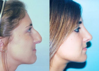 Teen Rhinoplasty + Septoplasty before 297515