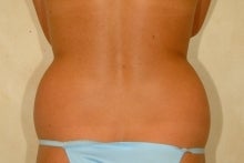 Liposuction of Hip Rolls before 149282
