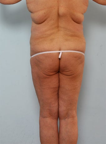 Body Lift before 260129