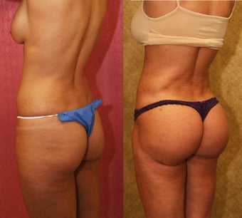 Brazilian Butt Lift 637894