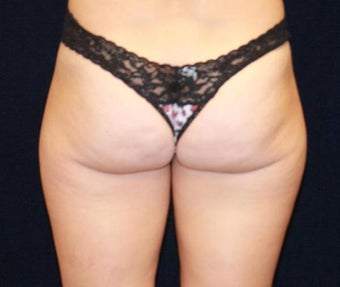 Liposuction of Saddlebags 494851