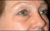 Eyelid Surgery before 373477