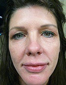 Hydrelle Injection for Treating Laugh Lines or Nasolabial Folds before 196055