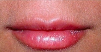 Lip enhancement after 374296