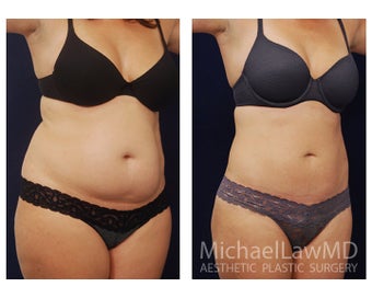 Liposuction after 397106