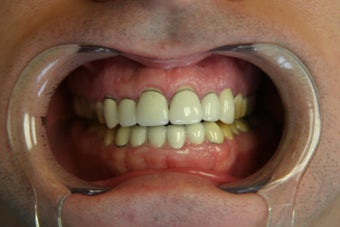 preventative decay treatment before 362259