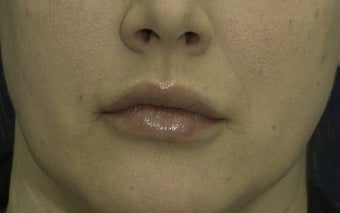 Lip Lift before 606639
