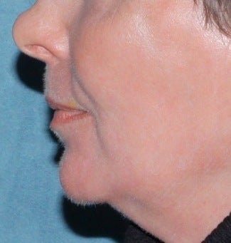Laser resurfacing for mouth after 376158
