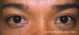 Male Asian Eyelid Surgery after 526428