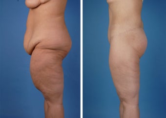 Lower Body Lift and Thighplasty after 335986