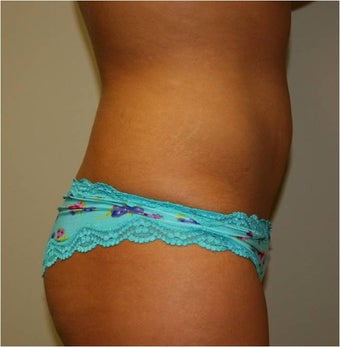 Smart Lipo Abdomen Side View after 109299
