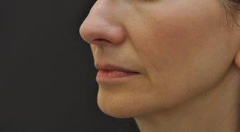 Juvederm Ultra before 194332