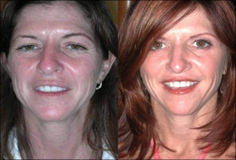 FX Laser Peel, Botox before 512741