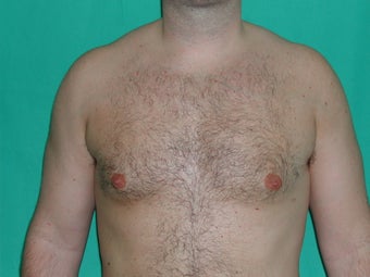 Gynecomastia treated by Liposuction after 117049