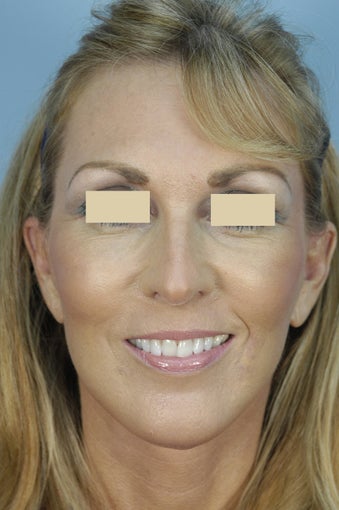 Qt Mini-Facelift with chin augmentation after 163550
