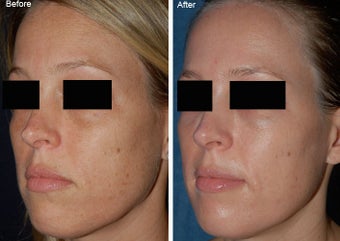 Fraxel Laser Resurfacing before 97892
