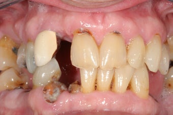 Dental implants, all porcelain crowns before 503161