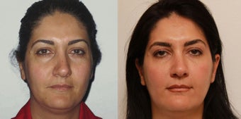 Facial Rejuvenation, non-surgical before 450125