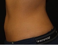 Coolsculpting-lower abdomen 445738