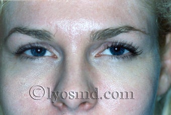 Endoscopic Browlift and CO2 Laser Resurfacing - Facelift before 224618