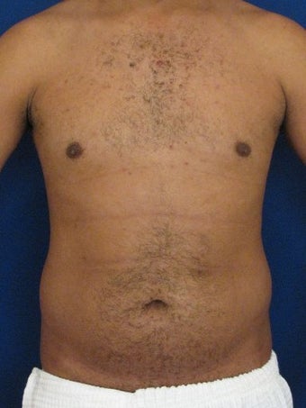 Vaser Hi Def Liposuction of the abdomen, chest, back, and flanks with fat injections to the pectoralis region before 422699