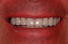 Smile Makeover With Empress All Ceramic Crowns after 96899