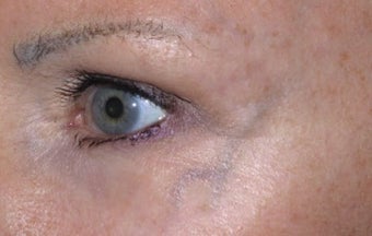Facial vein removal before 374364