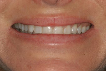 Porcelain Veneers before 213072