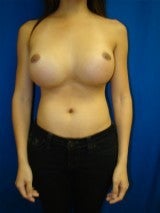 Revision Breast Surgery before 356593
