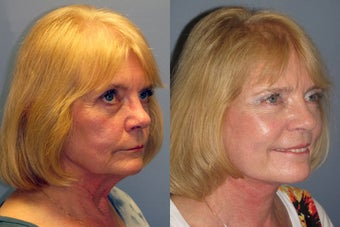 Lite Lift™, liposuction of the neck before 523704