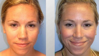 Rhinoplasty before 163629