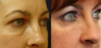 Juvederm Ultra before 513006