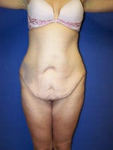 Tummy Tuck after Massive Weight Loss before 124953