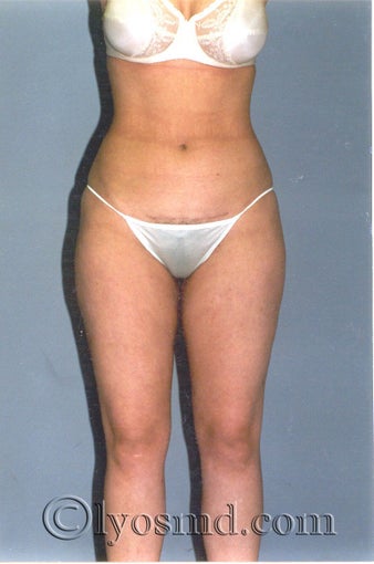 Liposuction after 225379